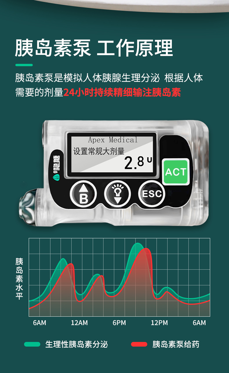 最新全自動(dòng)胰島素泵，糖尿病管理的革命性進(jìn)步，全自動(dòng)胰島素泵，糖尿病管理的突破性革新