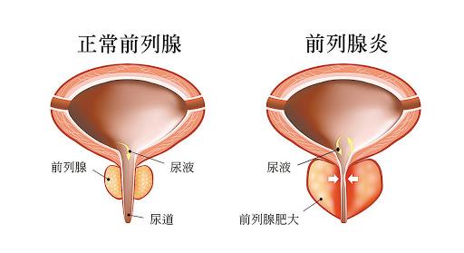 關(guān)于前列腺與性功能的關(guān)系，探究兩者之間的關(guān)聯(lián)與影響，前列腺與性功能關(guān)系探究，關(guān)聯(lián)與影響分析