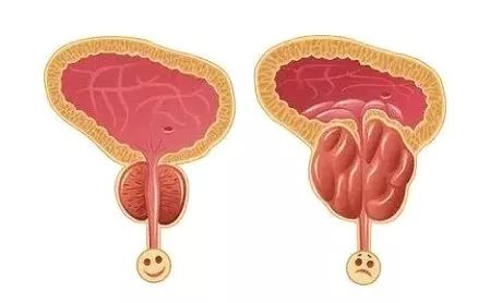 老公的前列腺增大挑戰(zhàn)，理解、支持與共同對(duì)抗，老公前列腺增大，理解、支持與共同應(yīng)對(duì)的挑戰(zhàn)