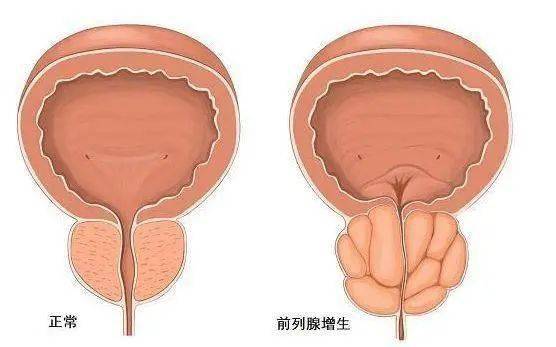 前列腺鈣化，一種常見的前列腺疾病及其相關(guān)知識解析，前列腺鈣化解析，常見疾病與相關(guān)知識探討