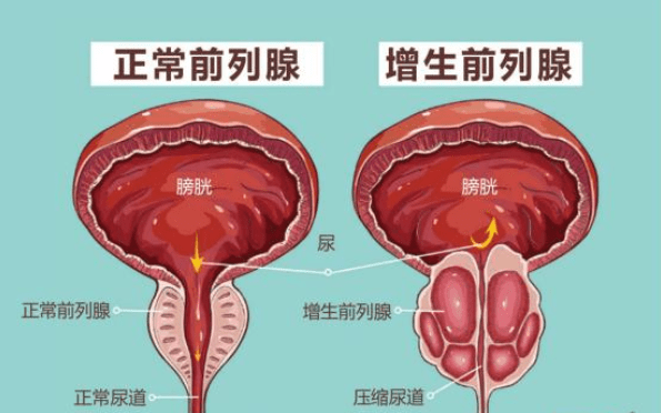 前列腺增生大小標(biāo)準(zhǔn)，理解其關(guān)鍵要素與影響，前列腺增生大小標(biāo)準(zhǔn)詳解，關(guān)鍵要素與影響因素解析