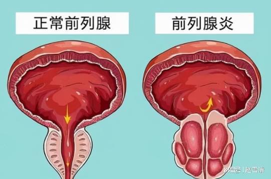 男性前列腺炎的癥狀解析，男性前列腺炎的癥狀詳解