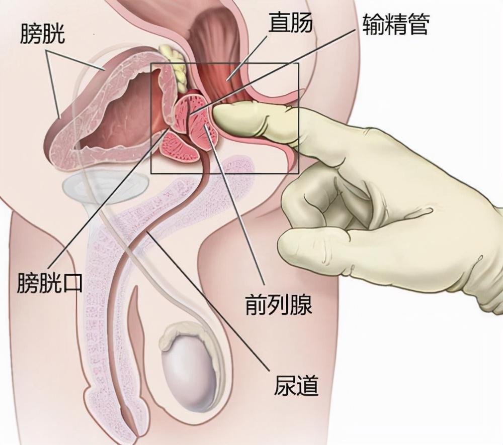 前列腺炎，重新認(rèn)識(shí)男性健康的誤區(qū)，重新認(rèn)識(shí)男性健康誤區(qū)，前列腺炎解析