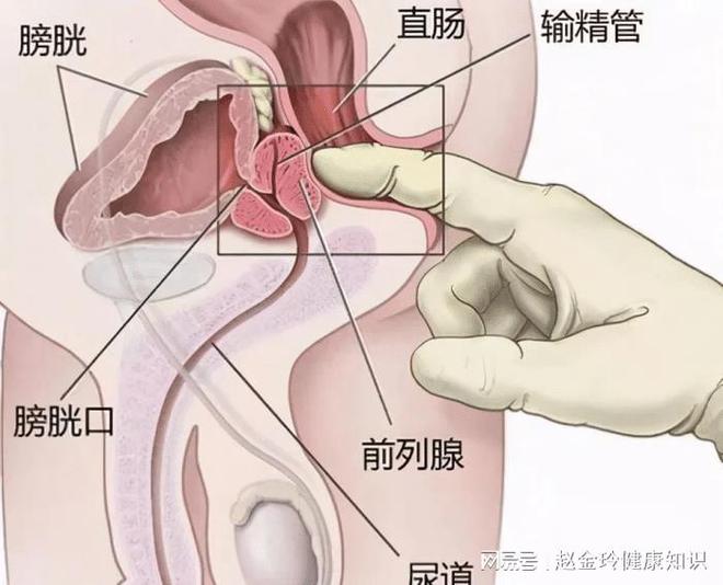 慢性前列腺炎，能否徹底治愈？解析與探討，慢性前列腺炎的治愈可能性解析與探討