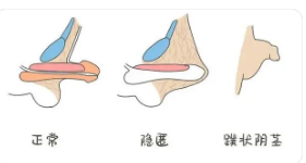 關(guān)于做包皮手術(shù)的費(fèi)用分析，包皮手術(shù)費(fèi)用詳解