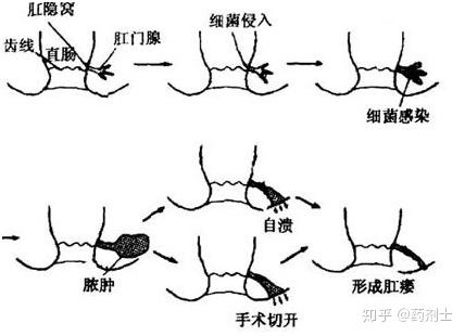 陽瘺