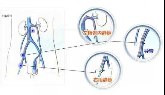 右邊睪丸隱痛會(huì)自愈嗎？解析原因與應(yīng)對(duì)之道，右邊睪丸隱痛，原因解析與自愈可能性探討