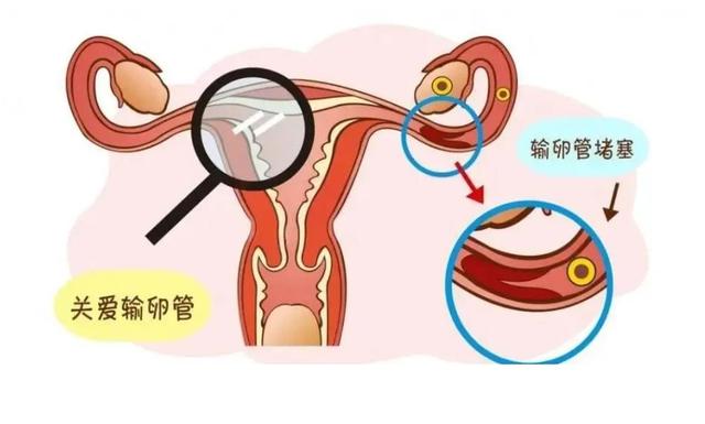 輸卵管堵塞的癥狀表現(xiàn)與解析，輸卵管堵塞的癥狀、表現(xiàn)與解析