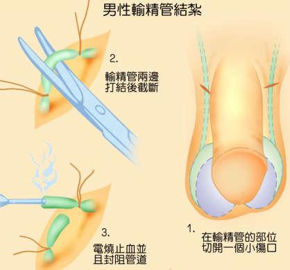 為什么醫(yī)院不提倡男性結(jié)扎，探究背后的原因與考量，探究醫(yī)院不提倡男性結(jié)扎的背后原因與考量