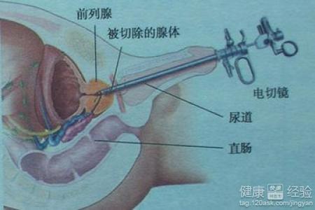 如何控制前列腺增生，如何控制前列腺增生的發(fā)展及癥狀？