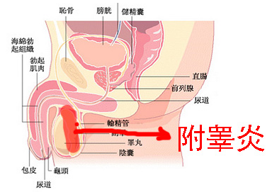 附睪炎，絕望中的希望曙光，附睪炎，絕望中的希望之光