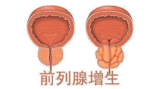 前列腺增生藥物治療效果評估與最佳用藥選擇，前列腺增生藥物治療效果評估及最佳用藥選擇探討